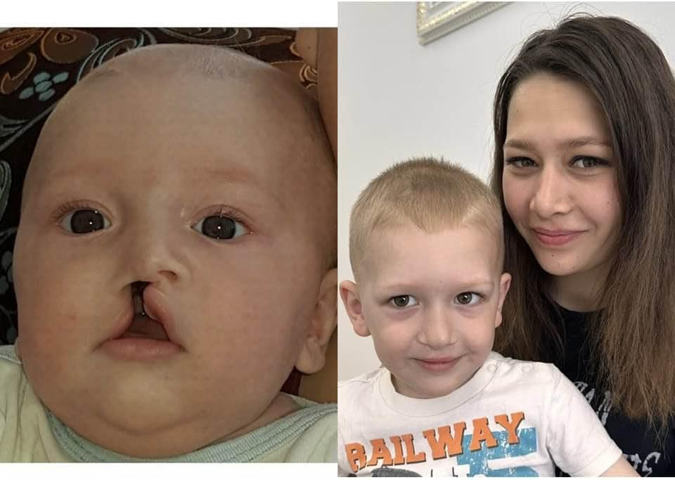 Незрощенням верхньої губи