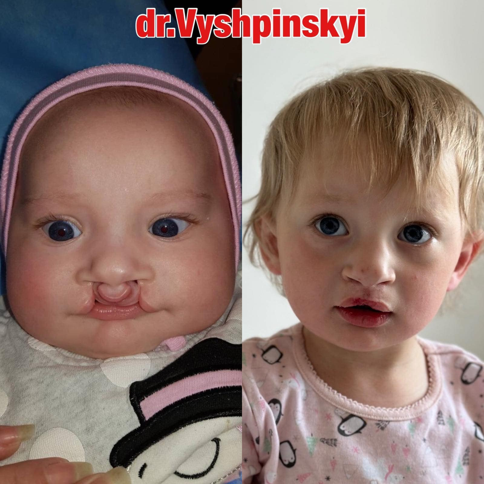 Вроджене двобічне наскрізне незрощення верхньої губи