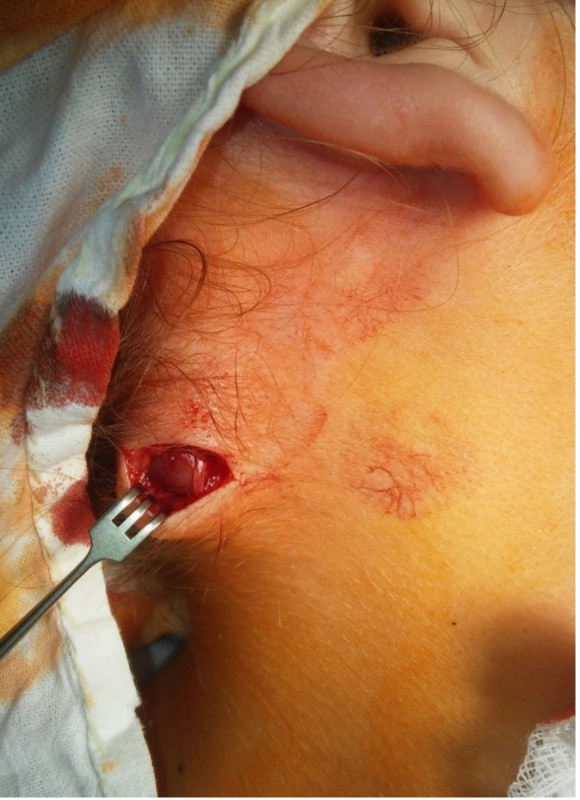 Біопсія лімфовузла задньо-верхньої третини шиї