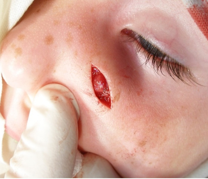 Дермоїдна кіста лівої носо-губної складки