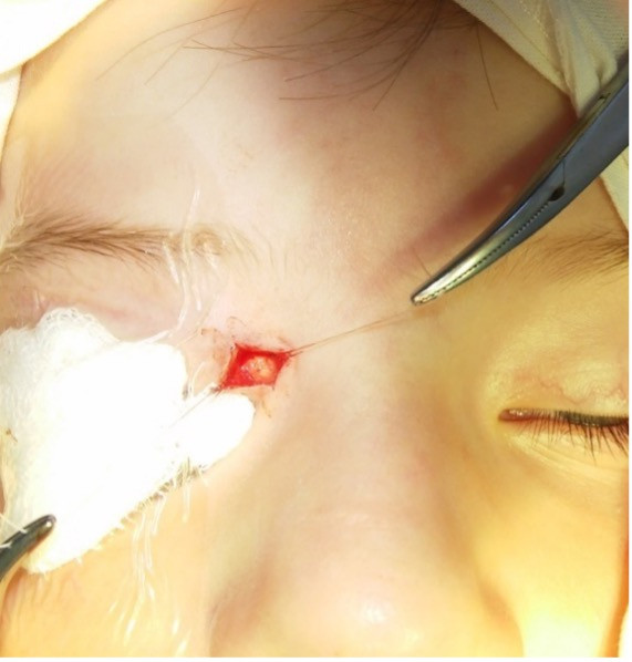 Дермоїдна кіста внутрішнього краю орбіти